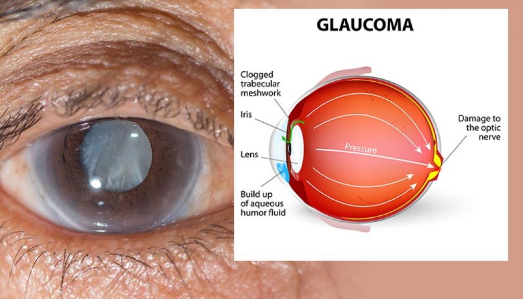 Degli 800.000 italiani con glaucoma, pari a circa il 2% degli over 40, circa 100.000 potrebbero trarre vantaggio da un intervento chirurgico che 'drena' via il liquido in eccesso all'interno dell'occhio.